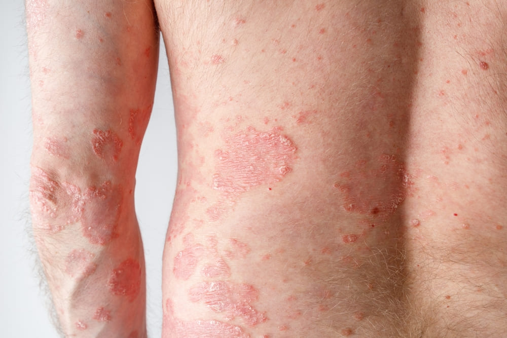 Síntomas, causas y factores de la psoriasis