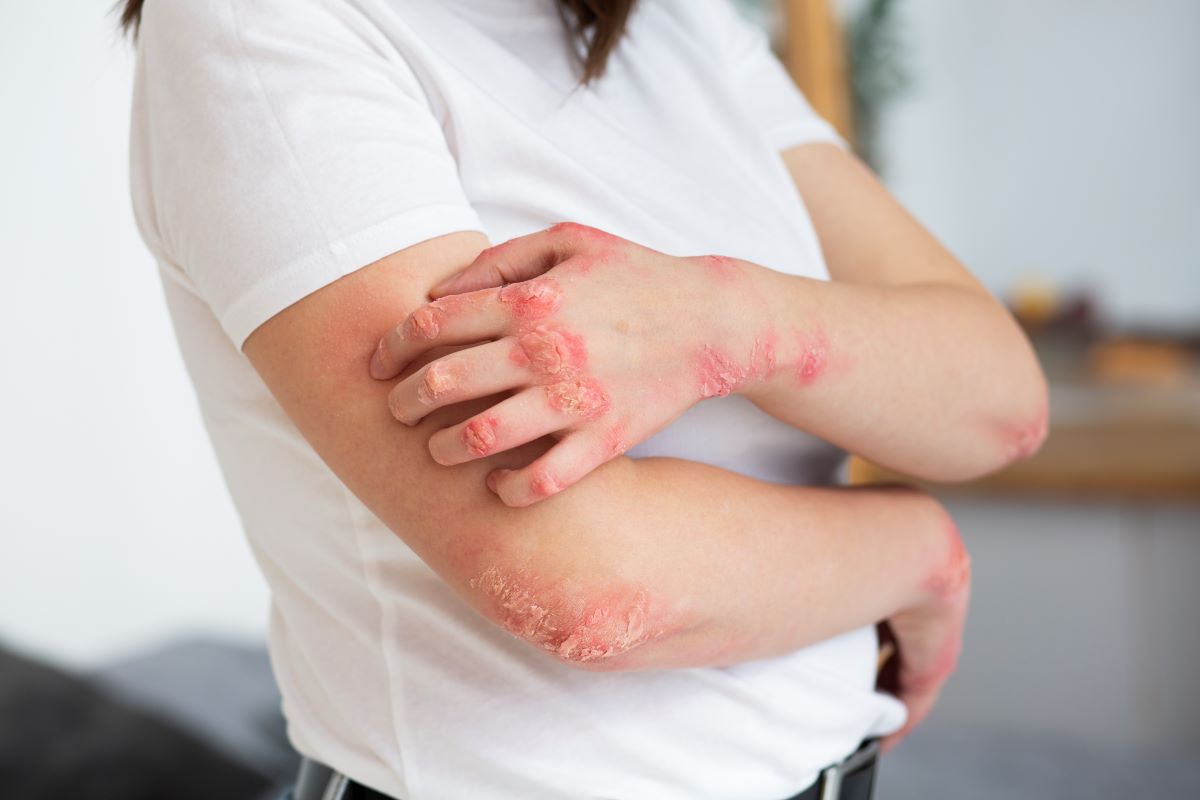 ¿Qué es la dermatitis seborreica?